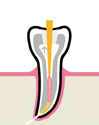 Вертикальная конденсация - введение горячей гуттаперчи